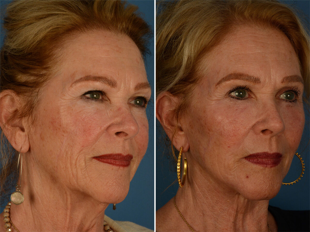 The UpLift™ Lower Face and Neck Lift Before and After Photos in Naples, FL, Patient 26854