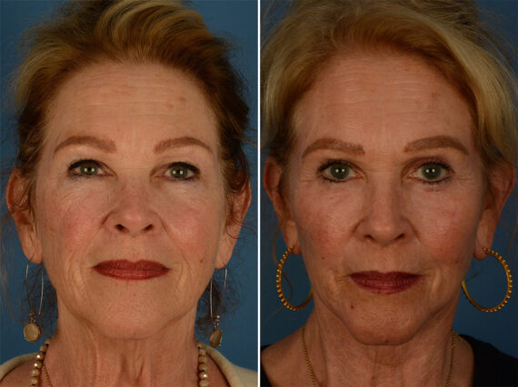 The UpLift™ Lower Face and Neck Lift Before and After Photos in Naples, FL, Patient 26854
