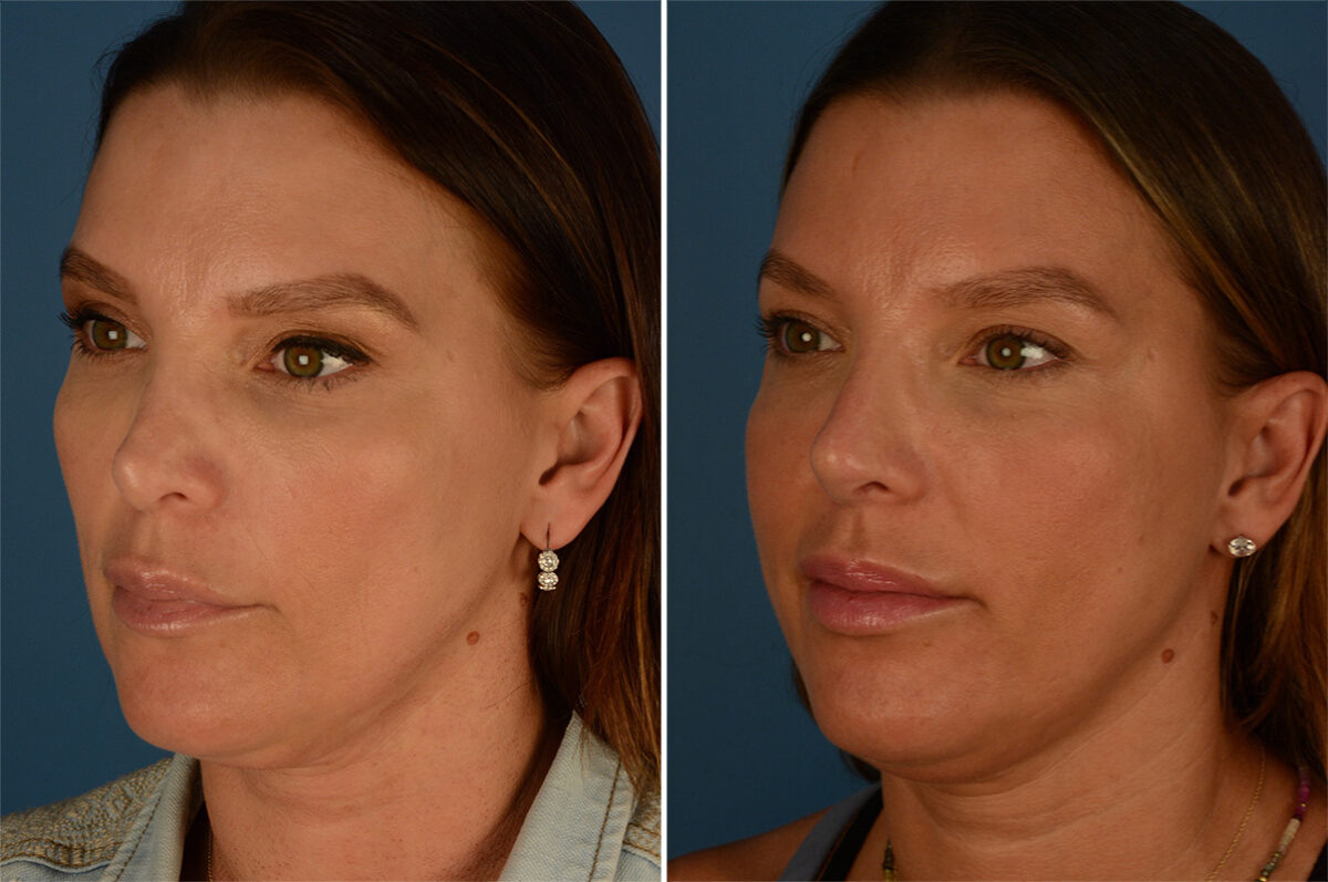 Revision Rhinoplasty Before and After Photos in Naples, FL, Patient 27114