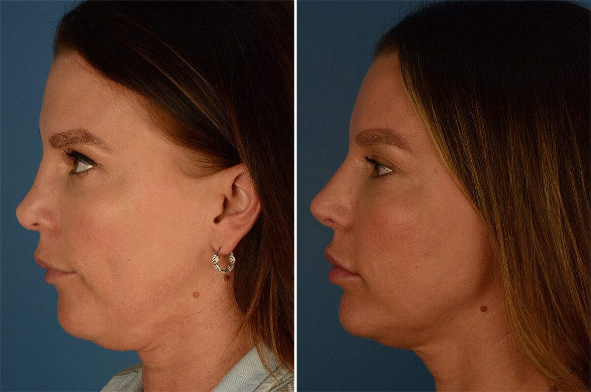 Revision Rhinoplasty Before and After Photos in Naples, FL, Patient 27114