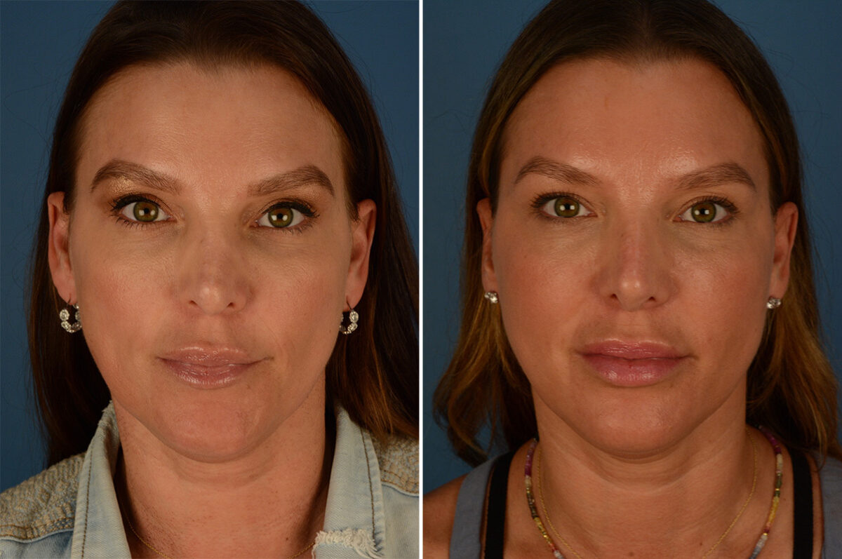 Revision Rhinoplasty Before and After Photos in Naples, FL, Patient 27114