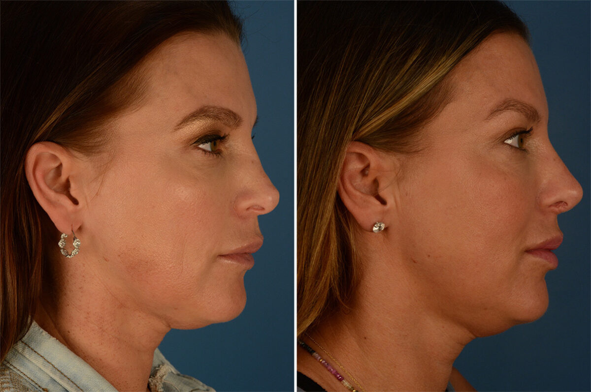 Revision Rhinoplasty Before and After Photos in Naples, FL, Patient 27114