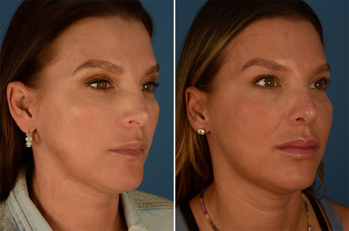 Revision Rhinoplasty Before and After Photos in Naples, FL, Patient 27114