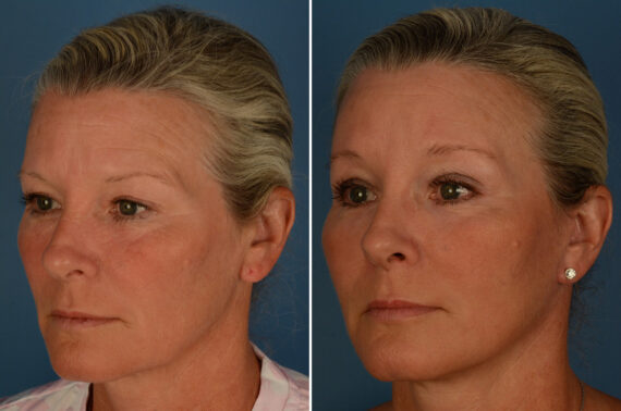 Blepharoplasty Before and After Photos in Naples, FL, Patient 27404