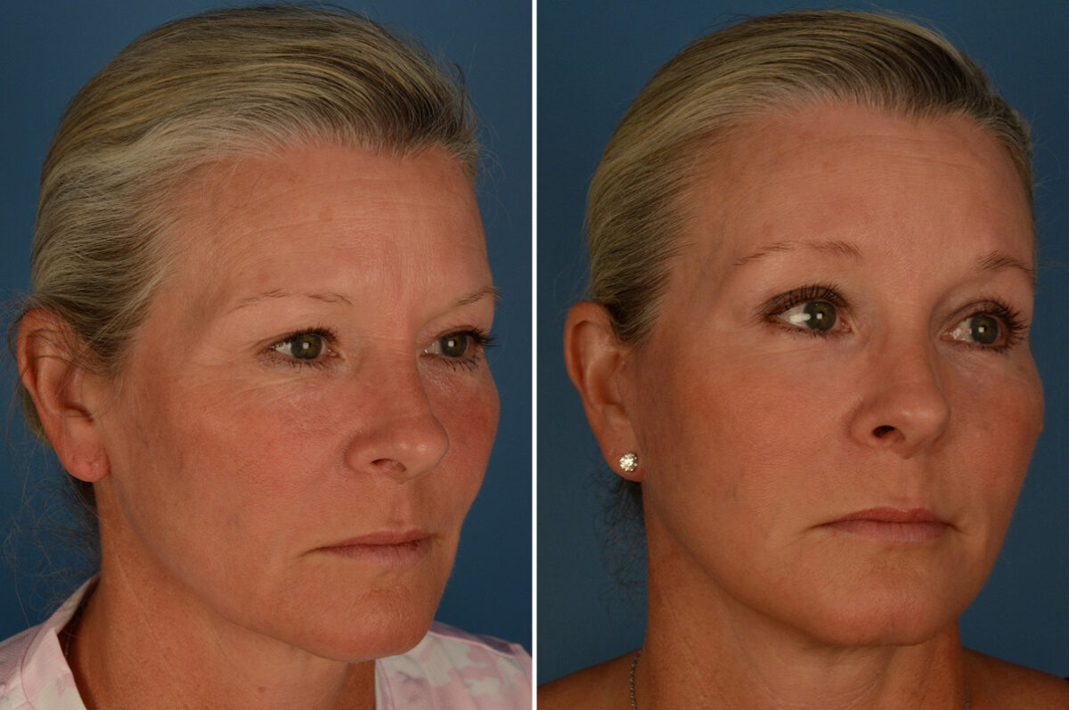 Blepharoplasty Before and After Photos in Naples, FL, Patient 27404