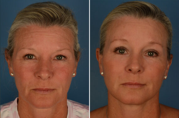 Blepharoplasty Before and After Photos in Naples, FL, Patient 27404