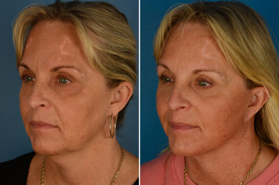 The UpLift™ Lower Face and Neck Lift Before and After Photos in Naples, FL, Patient 27433