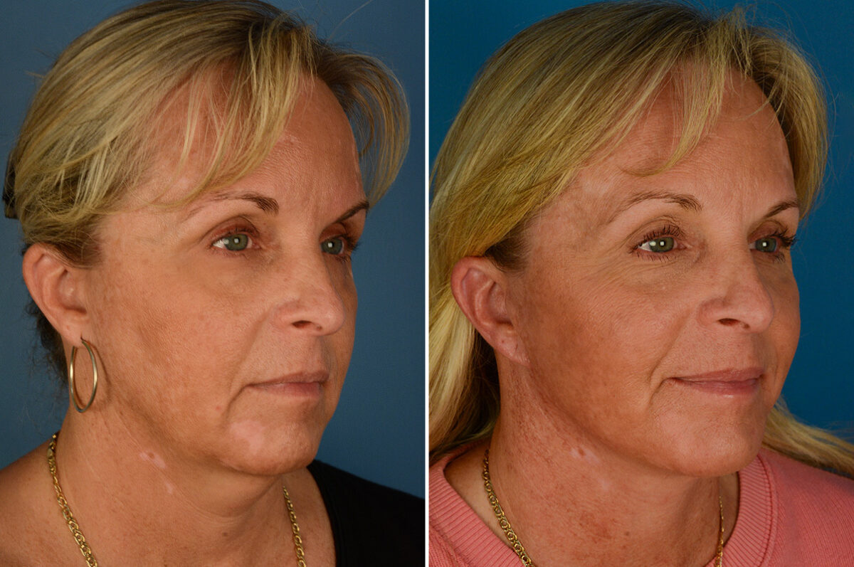 The UpLift™ Lower Face and Neck Lift Before and After Photos in Naples, FL, Patient 27433
