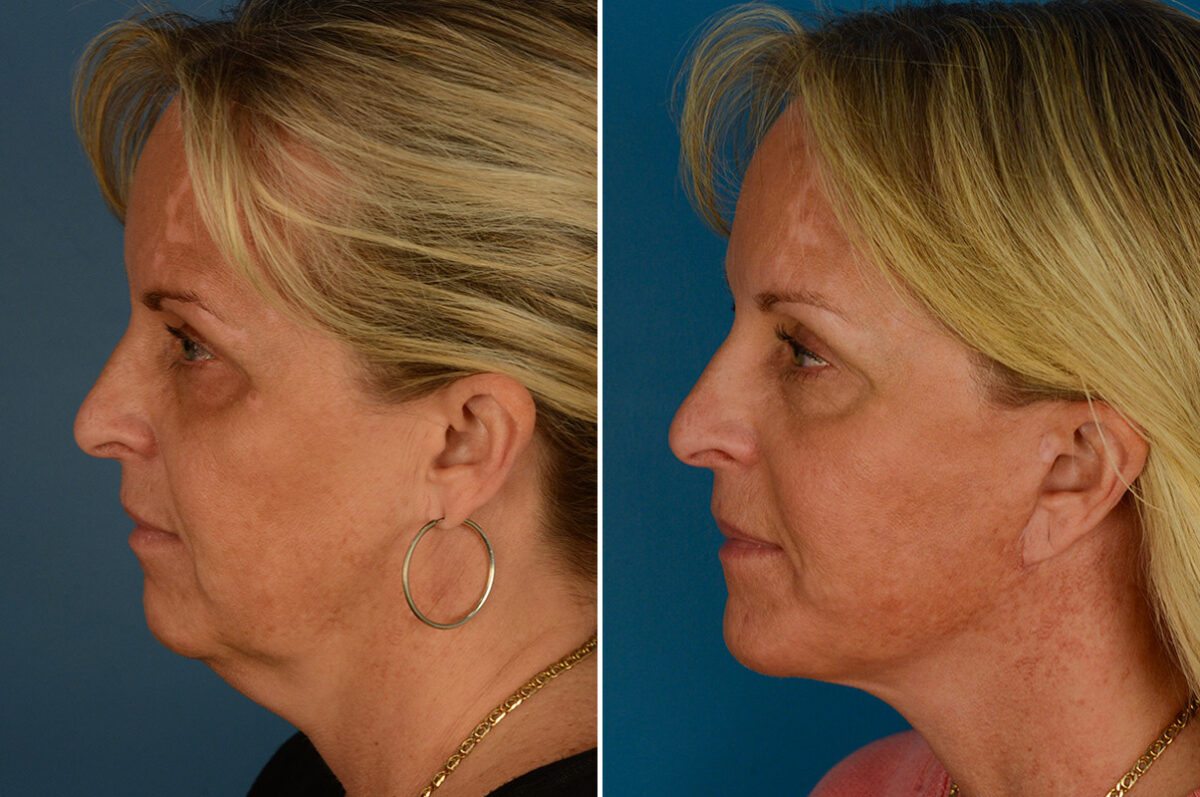 The UpLift™ Lower Face and Neck Lift Before and After Photos in Naples, FL, Patient 27433