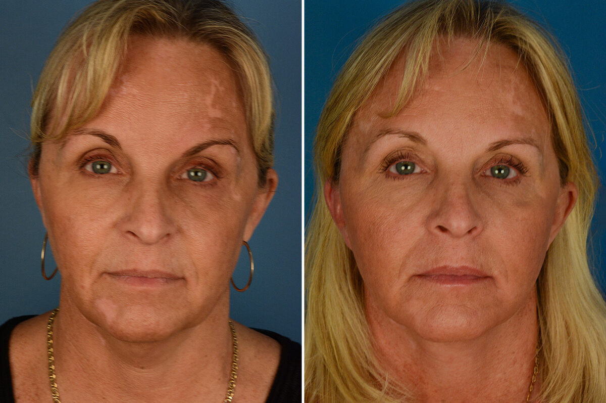 The UpLift™ Lower Face and Neck Lift Before and After Photos in Naples, FL, Patient 27433