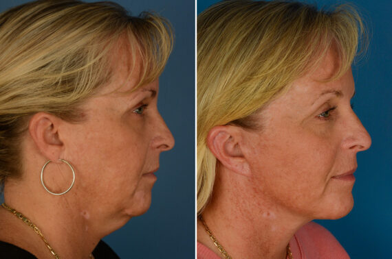 The UpLift™ Lower Face and Neck Lift Before and After Photos in Naples, FL, Patient 27433