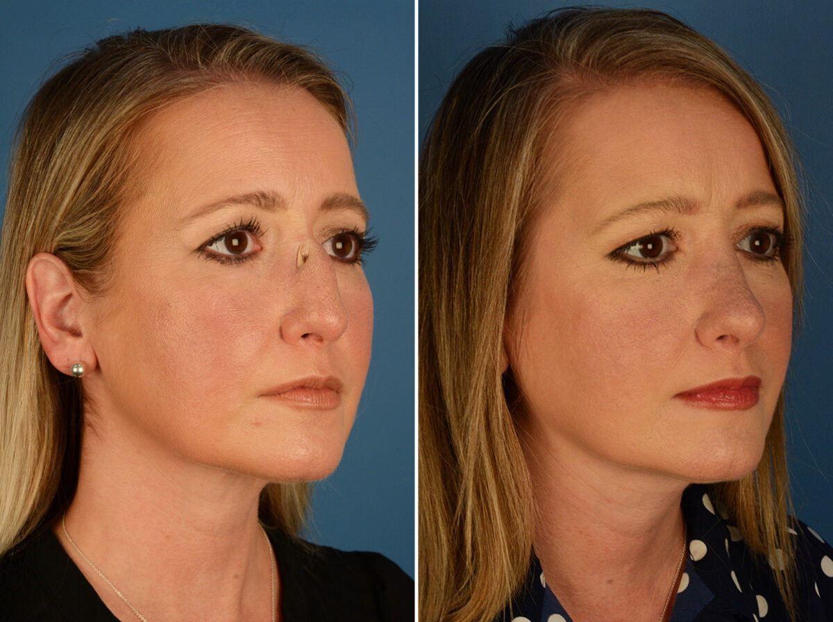 Revision Rhinoplasty Before and After Photos in Naples, FL, Patient 27628