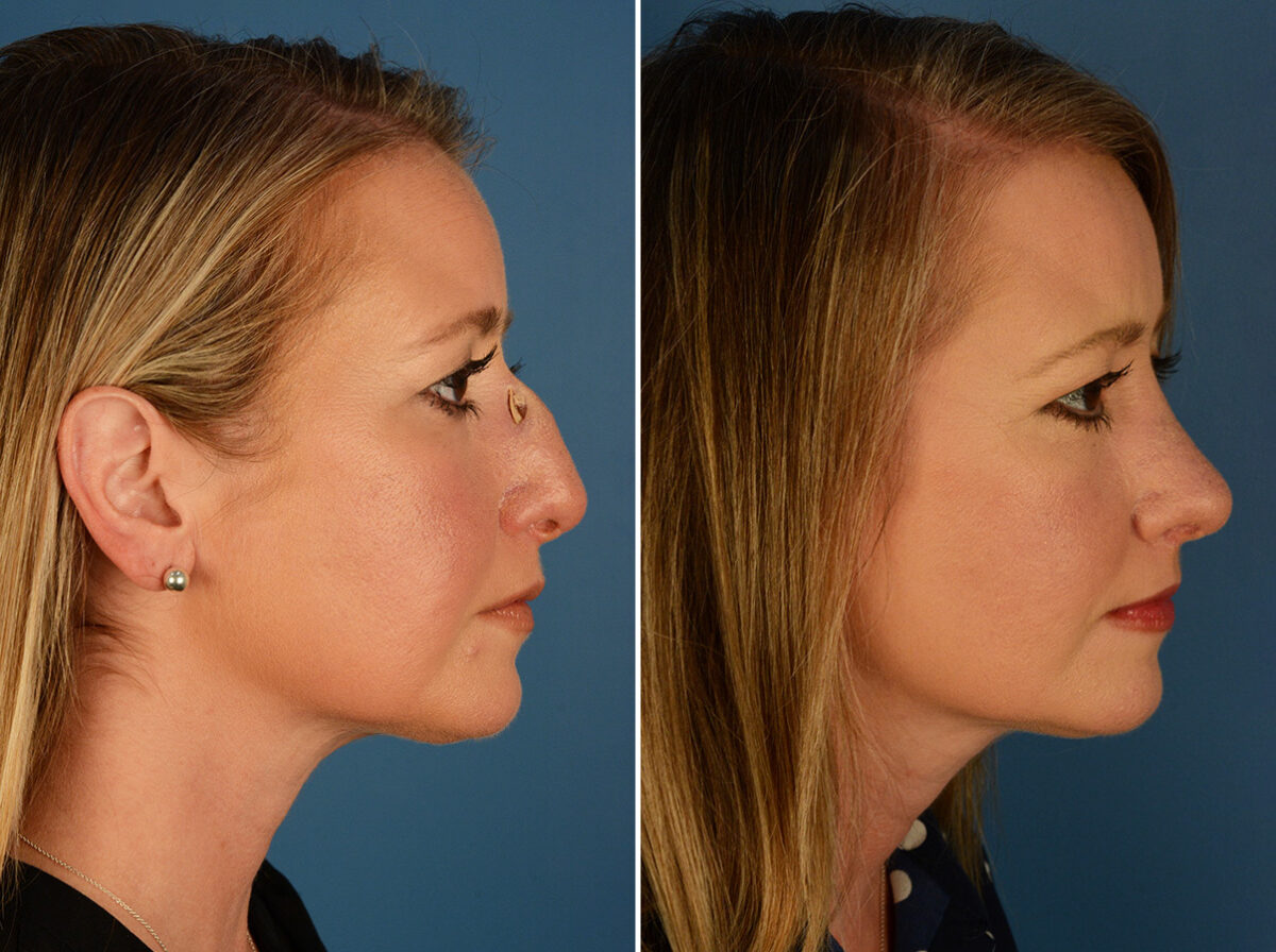 Revision Rhinoplasty Before and After Photos in Naples, FL, Patient 27628
