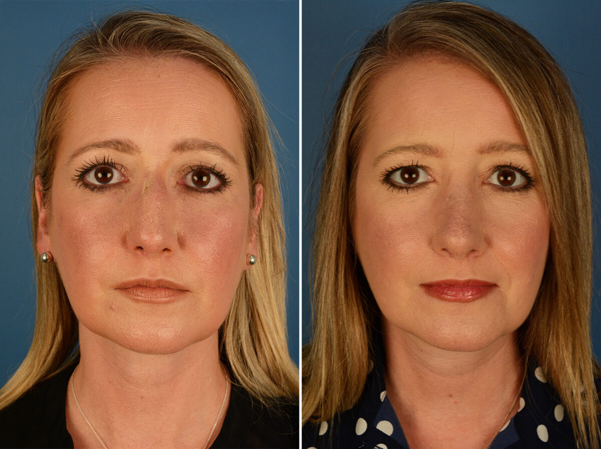 Revision Rhinoplasty Before and After Photos in Naples, FL, Patient 27628