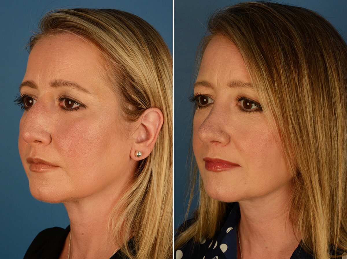 Revision Rhinoplasty Before and After Photos in Naples, FL, Patient 27628