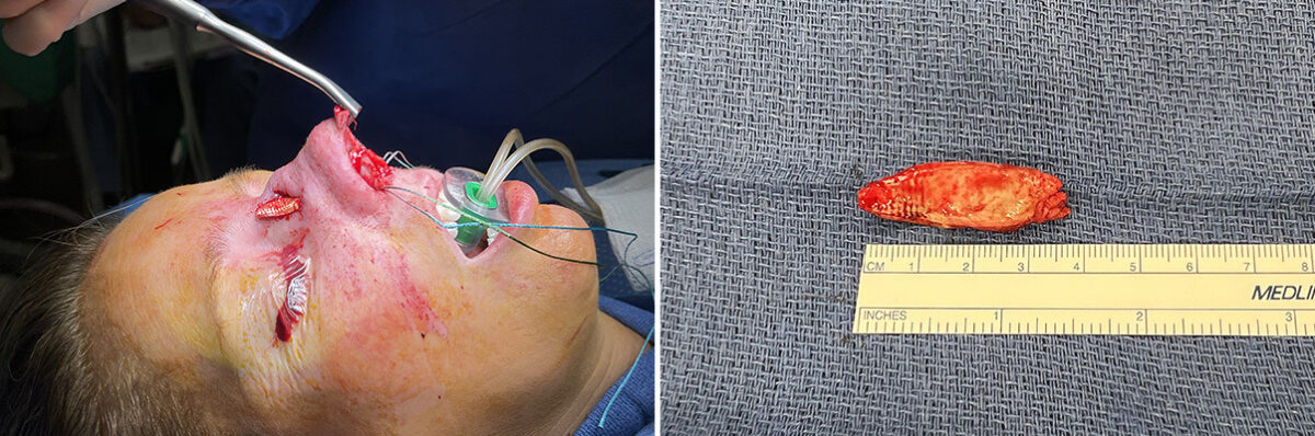 Revision Rhinoplasty Before and After Photos in Naples, FL, Patient 27628
