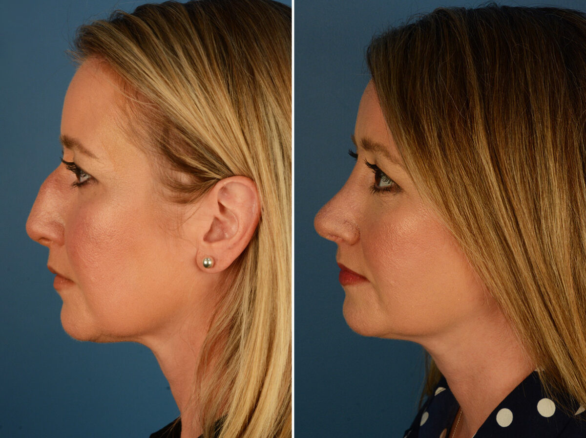 Revision Rhinoplasty Before and After Photos in Naples, FL, Patient 27628