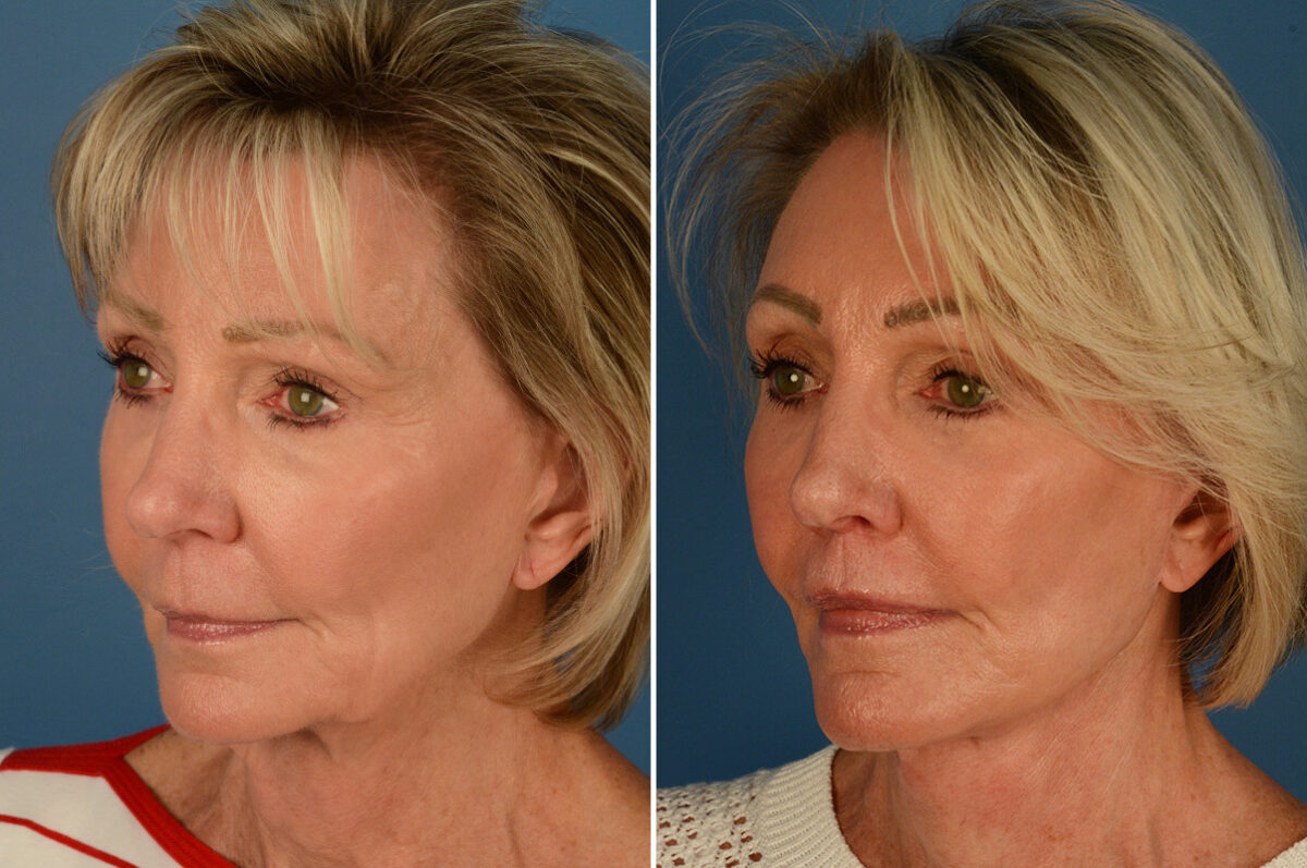 Lip Lift Before and After Photos in Naples, FL, Patient 27663