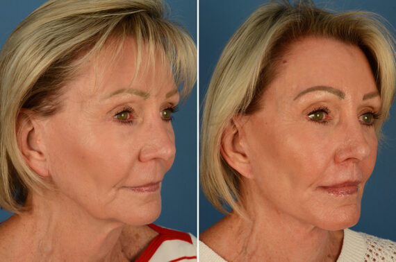 Lip Lift Before and After Photos in Naples, FL, Patient 27663