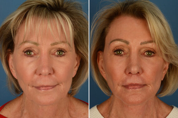 Lip Lift Before and After Photos in Naples, FL, Patient 27663