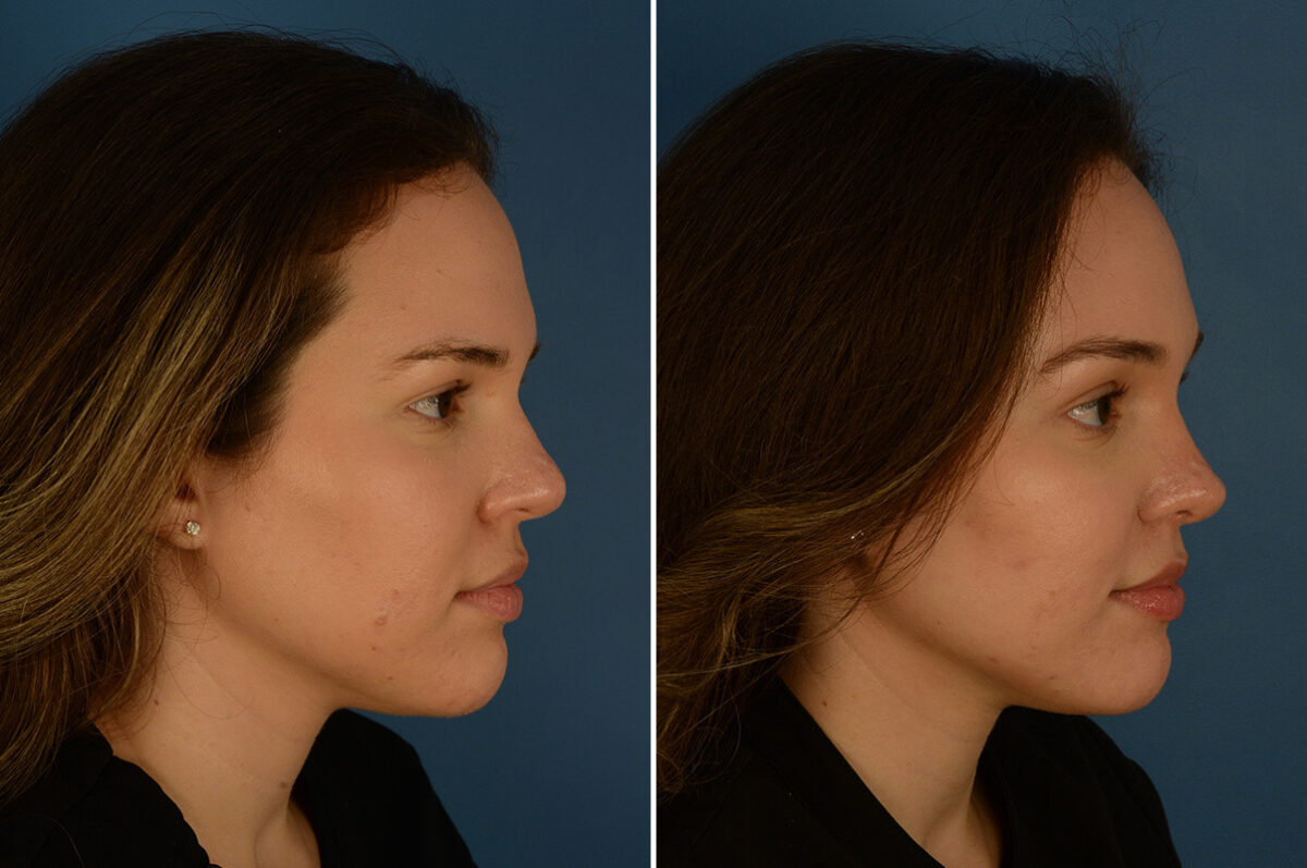 Eyebrow & Forehead Before and After Photos in Naples, FL, Patient 28229
