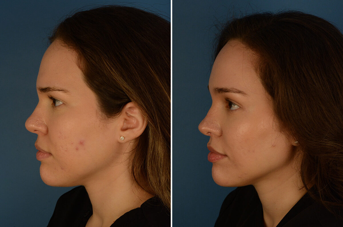 Eyebrow & Forehead Before and After Photos in Naples, FL, Patient 28229