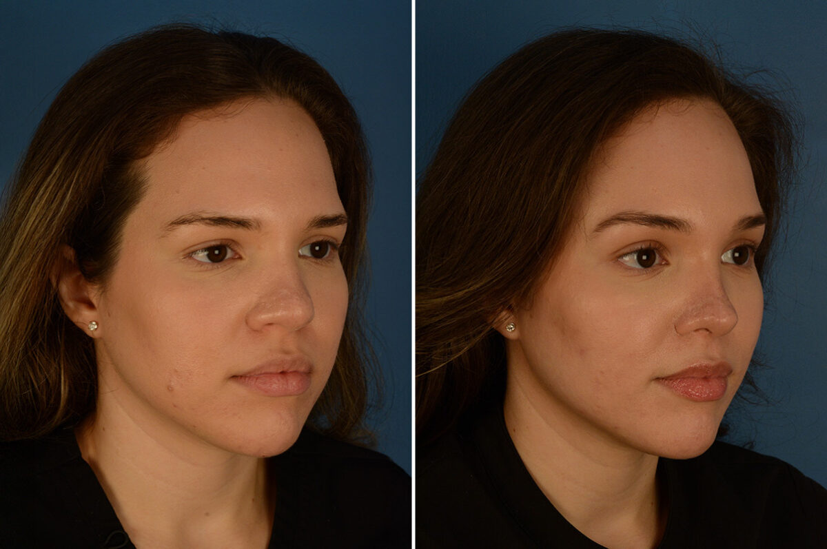 Eyebrow & Forehead Before and After Photos in Naples, FL, Patient 28229