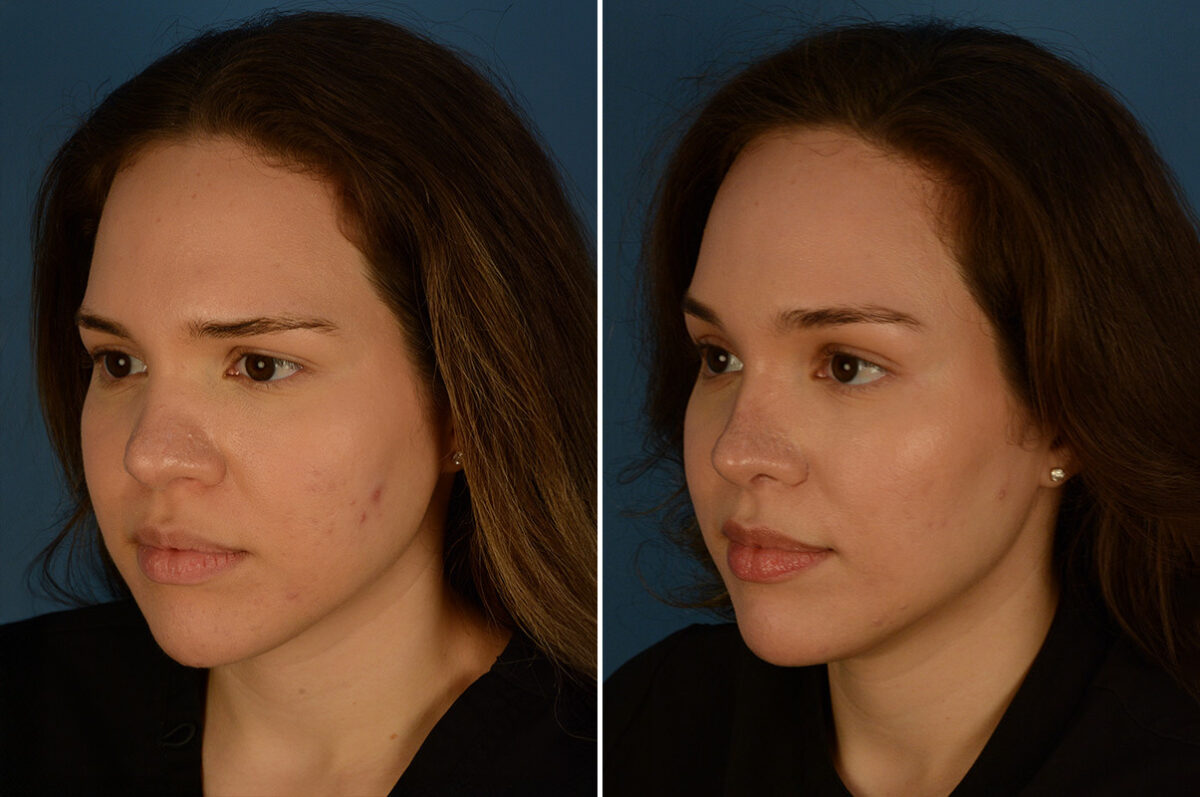 Eyebrow & Forehead Before and After Photos in Naples, FL, Patient 28229