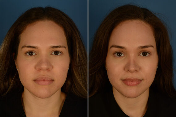 Eyebrow & Forehead Before and After Photos in Naples, FL, Patient 28229