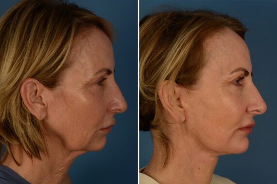 The UpLift™ Lower Face and Neck Lift Before and After Photos in Naples, FL, Patient 28354