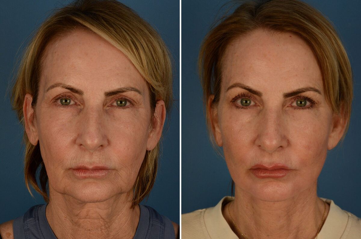 The UpLift™ Lower Face and Neck Lift Before and After Photos in Naples, FL, Patient 28354