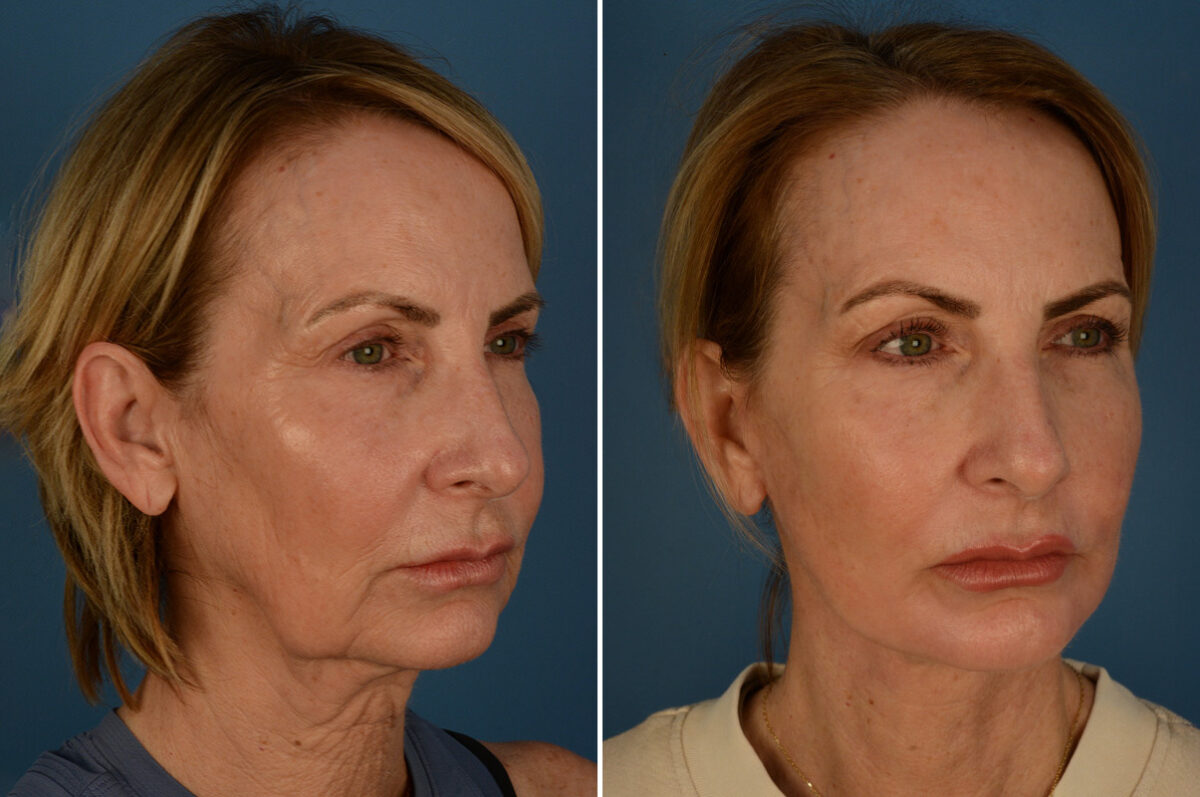 The UpLift™ Lower Face and Neck Lift Before and After Photos in Naples, FL, Patient 28354