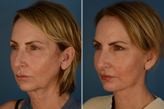 The UpLift™ Lower Face and Neck Lift Before and After Photos in Naples, FL, Patient 28354