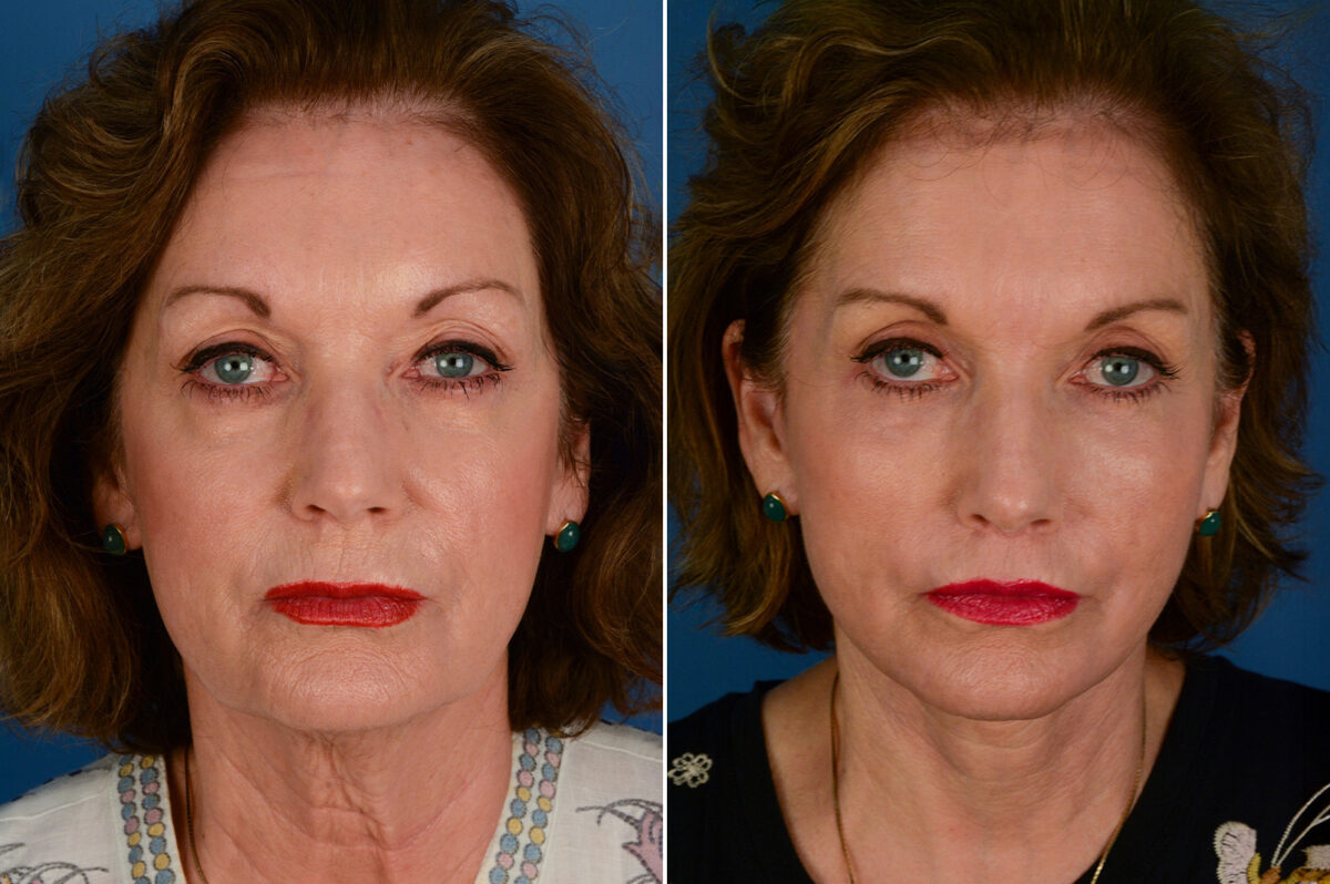 Endoscopic Facelift Before and After Photos in Naples, FL, Patient 29343