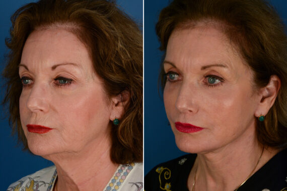 Endoscopic Facelift Before and After Photos in Naples, FL, Patient 29343