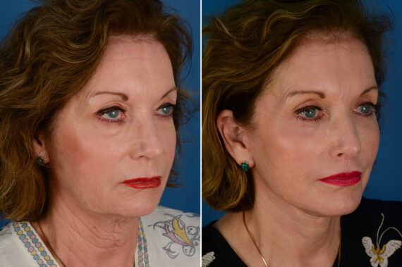 Endoscopic Facelift Before and After Photos in Naples, FL, Patient 29343