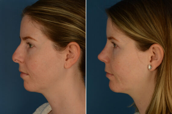 Chin Implant Before and After Photos in Naples, FL, Patient 29376
