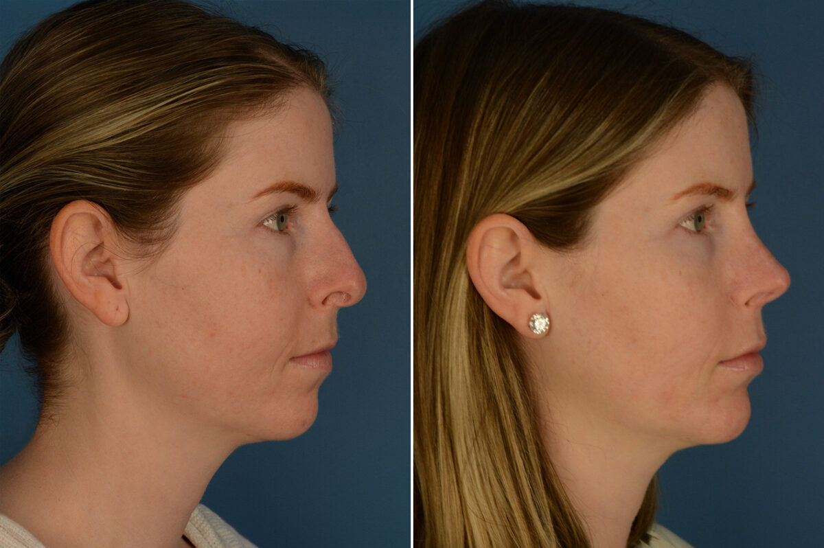 Chin Implant Before and After Photos in Naples, FL, Patient 29376