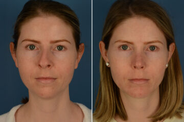 Chin Implant Before and After Photos in Naples, FL, Patient 29376