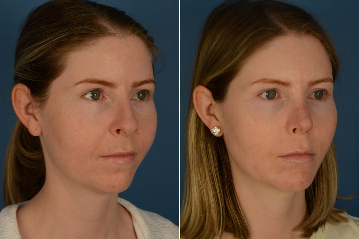 Chin Implant Before and After Photos in Naples, FL, Patient 29376