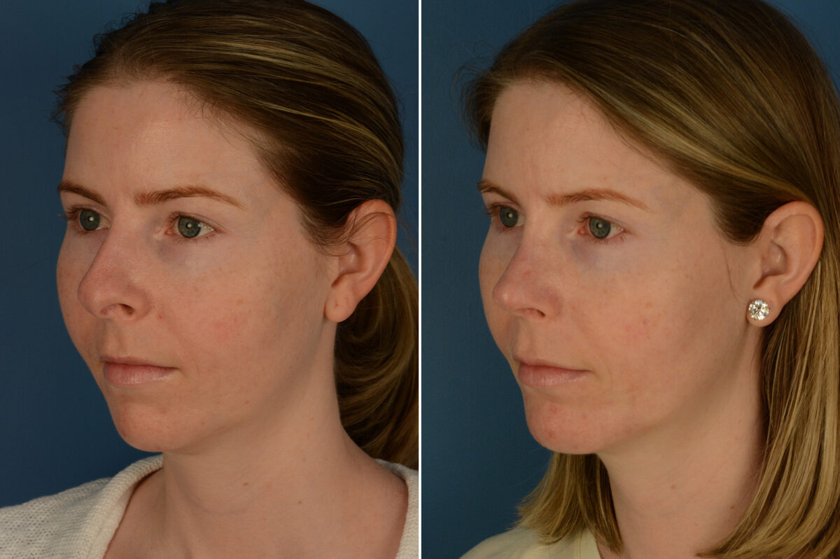 Chin Implant Before and After Photos in Naples, FL, Patient 29376