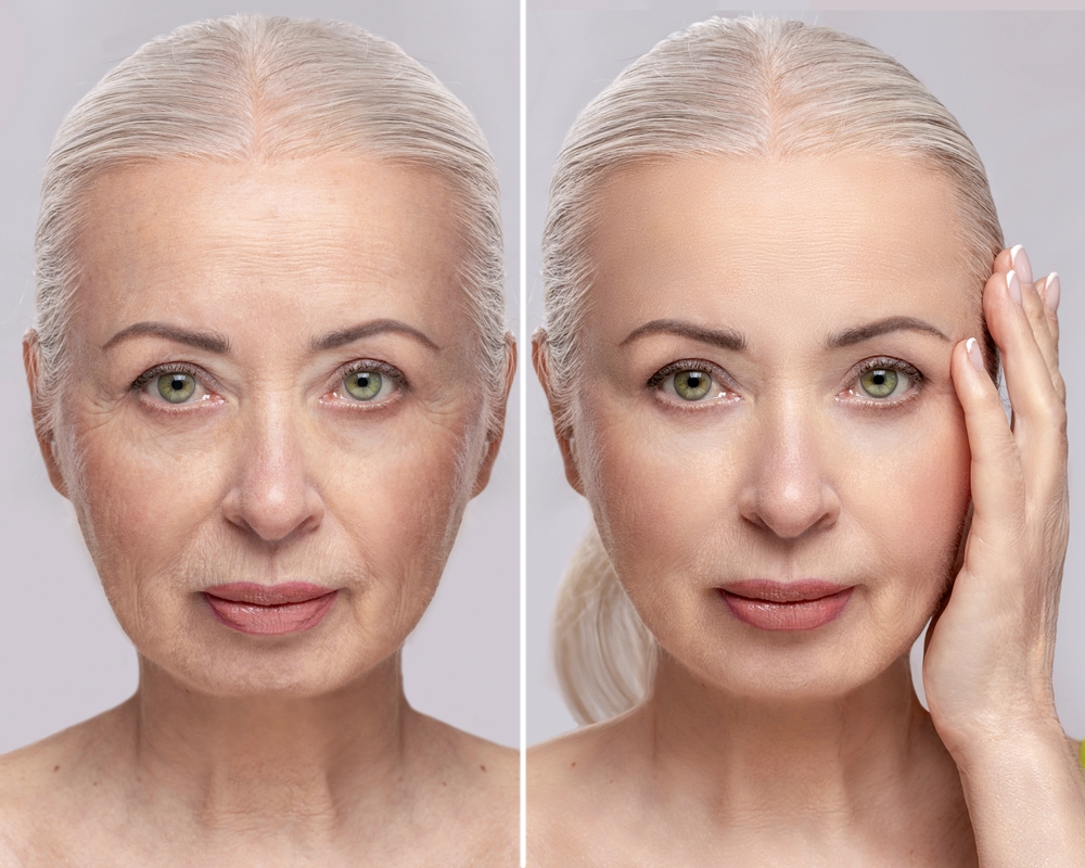 Side-by-side image of mature woman before and after facelift showing smoother skin and youthful facial contours.