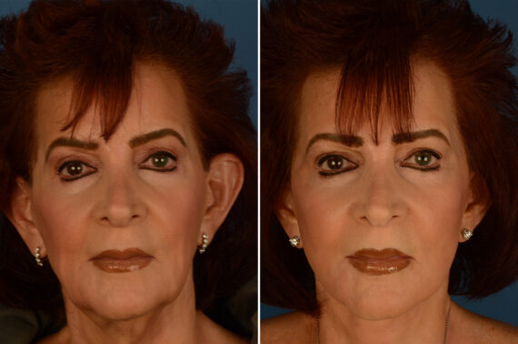 The UpLift™ Lower Face and Neck Lift Before and After Photos in Naples, FL, Patient 29515