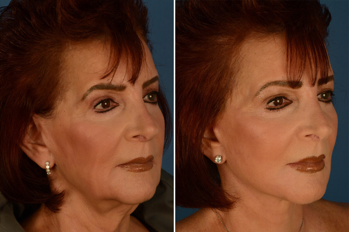 The UpLift™ Lower Face and Neck Lift Before and After Photos in Naples, FL, Patient 29515