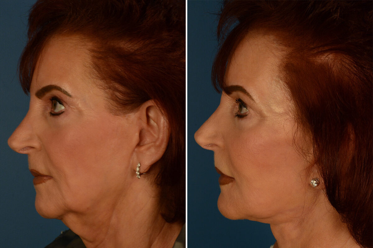 The UpLift™ Lower Face and Neck Lift Before and After Photos in Naples, FL, Patient 29515