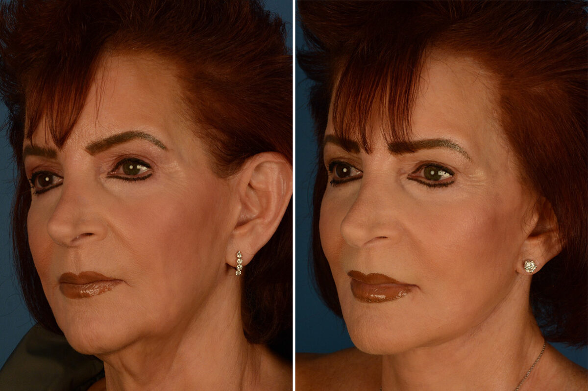 The UpLift™ Lower Face and Neck Lift Before and After Photos in Naples, FL, Patient 29515