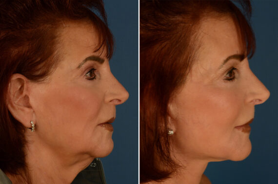 The UpLift™ Lower Face and Neck Lift Before and After Photos in Naples, FL, Patient 29515