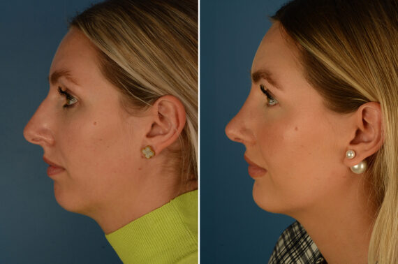 Chin Implant Before and After Photos in Naples, FL, Patient 29580