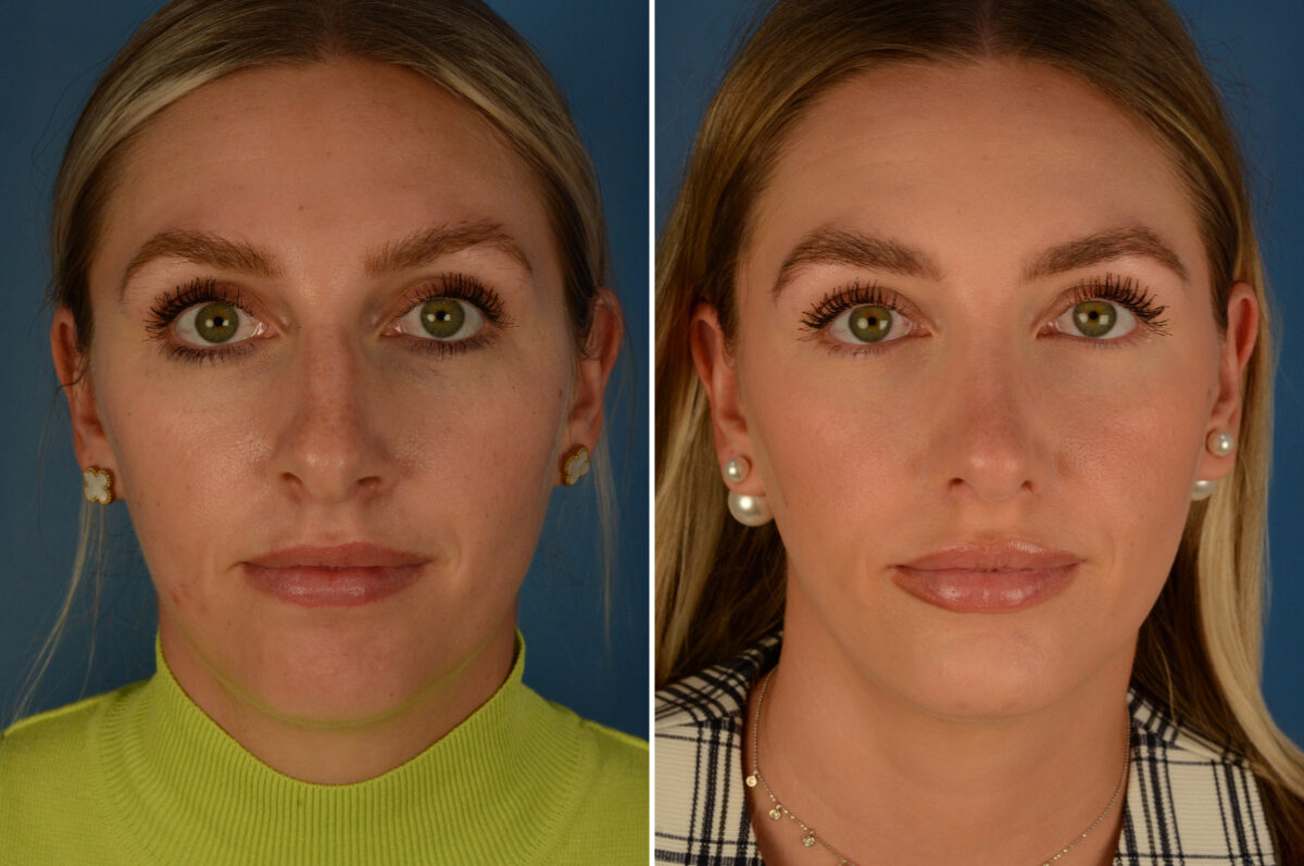 Chin Implant Before and After Photos in Naples, FL, Patient 29580