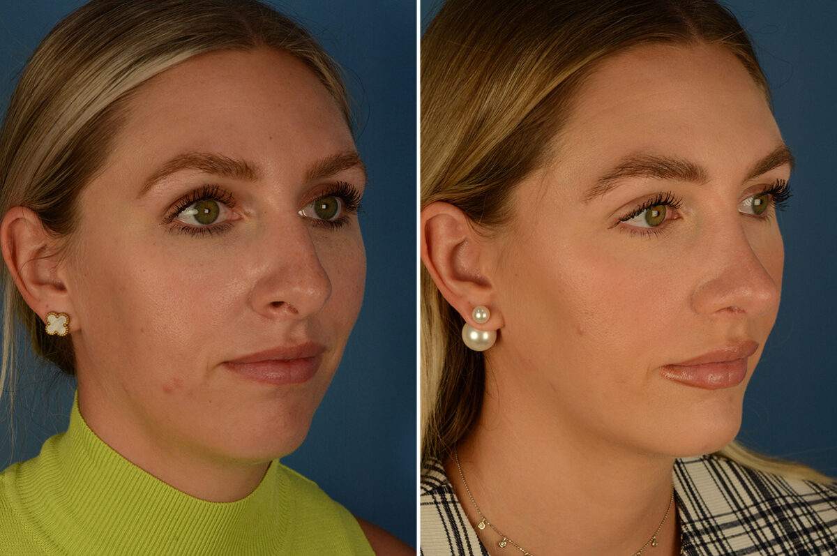 Chin Implant Before and After Photos in Naples, FL, Patient 29580